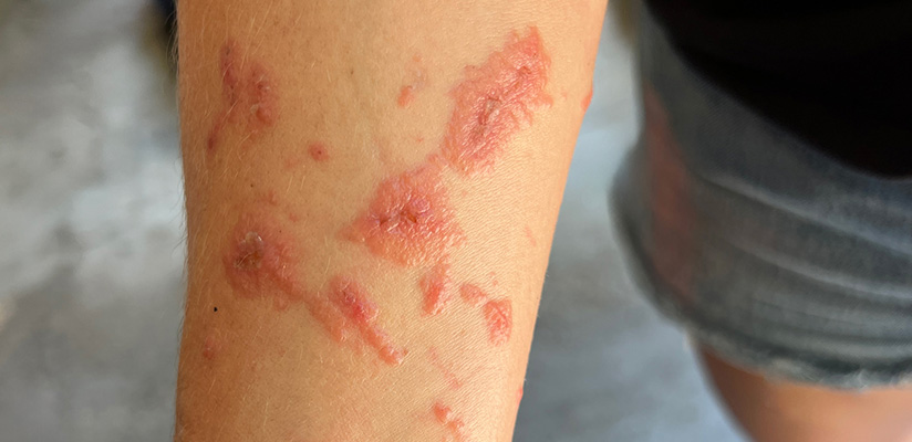 Rash pic.jpg